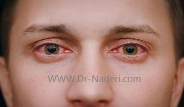 عفونت چشم Eye infections